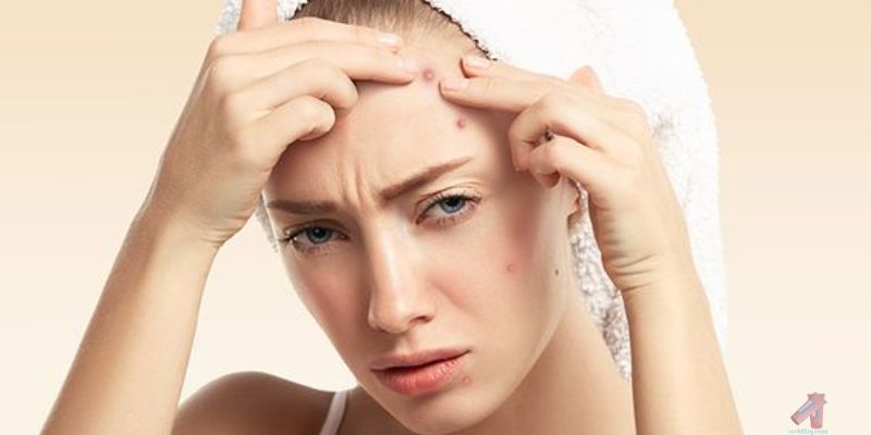 Understanding Acne and Its Causes