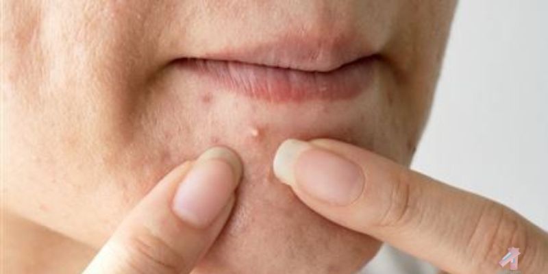 Understanding Chin Acne