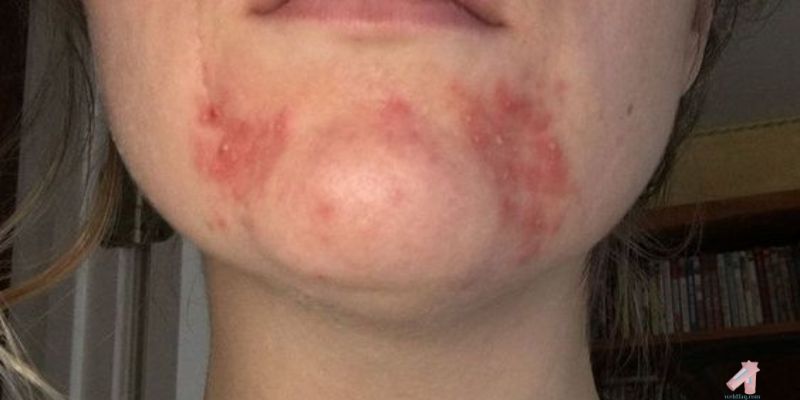 How to treat acne on chin at home