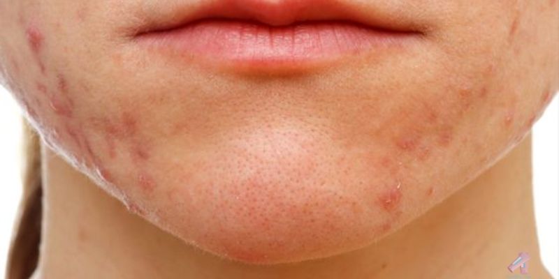 How to treat acne on chin at home